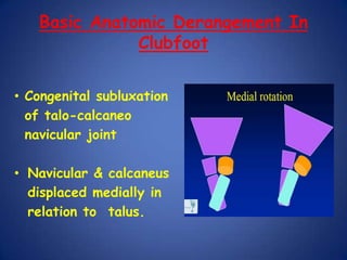 Basic Anatomic Derangement In ClubfootCongenital subluxation of talo-calcaneonavicular joint