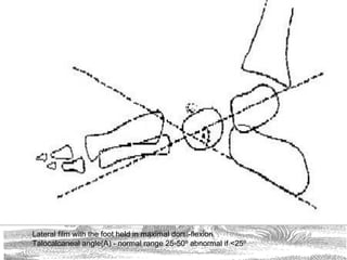 Lateral film with the foot held in maximal dorsi-flexion
Talocalcaneal angle(A) - normal range 25-50º abnormal if <25º
 