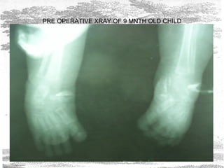 PRE OPERATIVE XRAY OF 9 MNTH OLD CHILD
 
