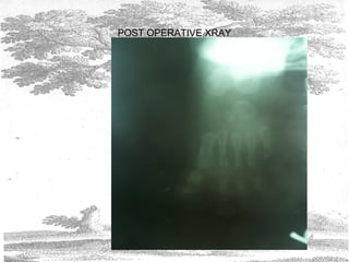 POST OPERATIVE XRAY
 