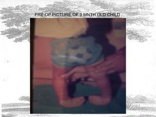 PRE OP PICTURE OF 9 MNTH OLD CHILD
 