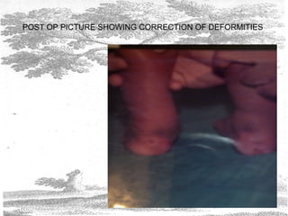 POST OP PICTURE SHOWING CORRECTION OF DEFORMITIES
 