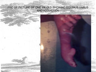 PRE OP PICTURE OF ONE YR OLD SHOWING EQUINUS VARUS
AND ADDUCTION
 