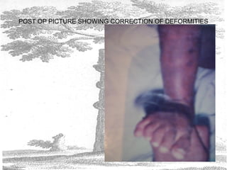 POST OP PICTURE SHOWING CORRECTION OF DEFORMITIES
 