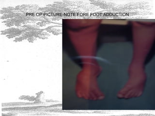 PRE OP PICTURE-NOTE FORE FOOT ADDUCTION
 
