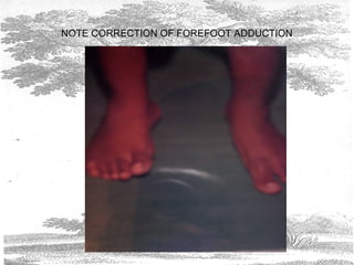 NOTE CORRECTION OF FOREFOOT ADDUCTION
 
