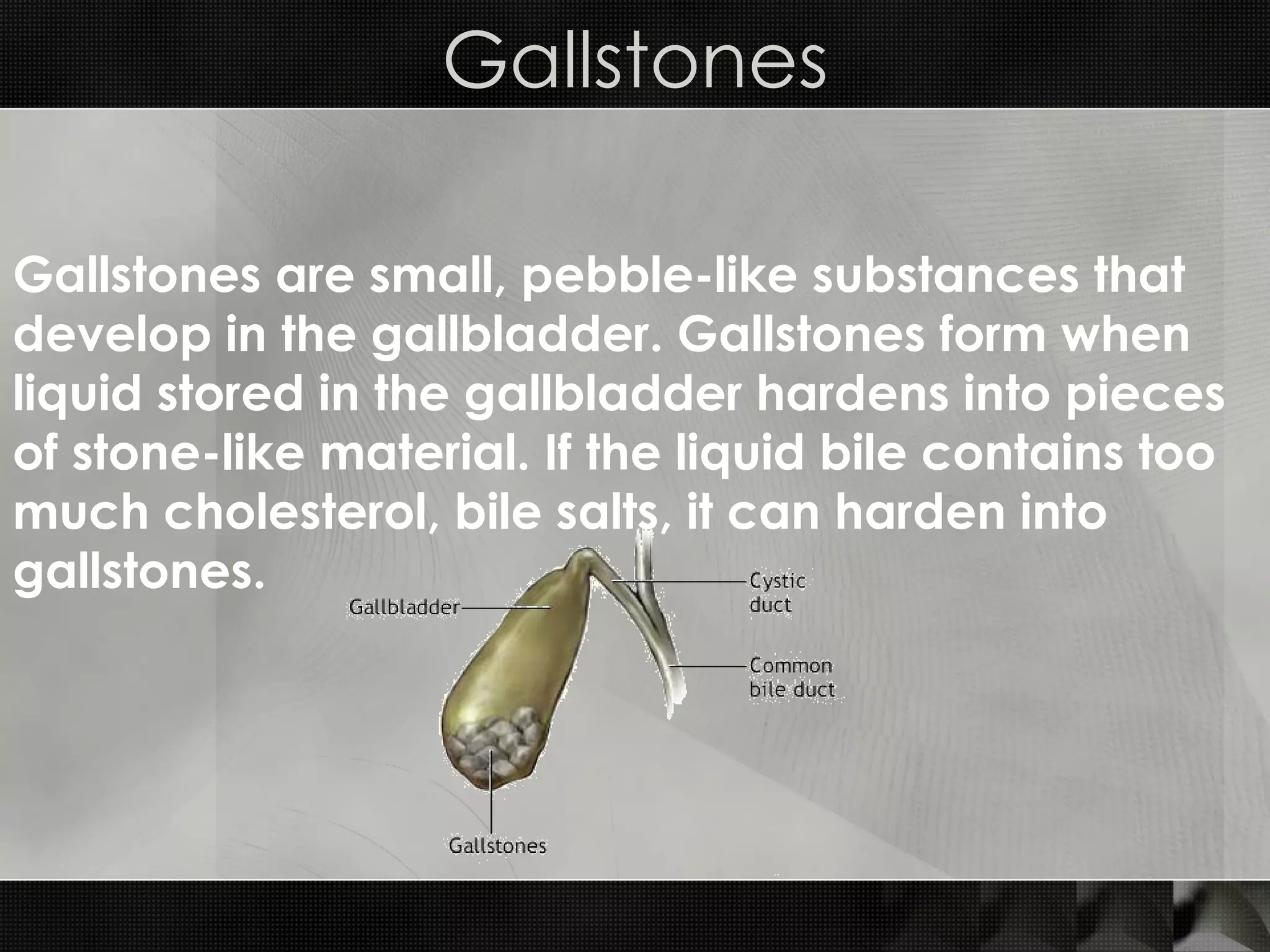 Gallstones Gallstones are small, pebble-like substances that develop in the gallbladder. Gallstones form when liquid stored in the gallbladder hardens into pieces of stone-like material. If the liquid bile contains too much cholesterol, bile salts, it can harden into gallstones. 