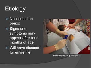 EtiologyNo incubation periodSigns and symptoms may appear after four months of ageWill have disease for entire lifeBone Marrow Operations 