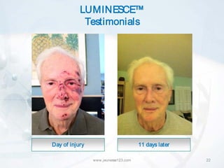 LUMINESCE™
            Testimonials




Day of injury                         11 days later

                www.jeunesse123.com                   22
 