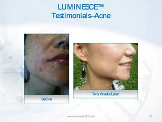 LUMINESCE™
     Testimonials–Acne




                          Two Weeks Later
Before



         www.jeunesse123.com                25
 