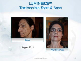 LUMINESCE™
Testimonials–Scars & Acne




   Before



 August 2011
                                  After Five Weeks



            www.jeunesse123.com                      26
 