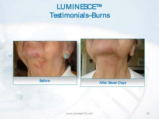 LUMINESCE™
     Testimonials–Burns




Before
                               After Seven Days




         www.jeunesse123.com                      28
 