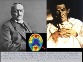 The doctor (left) observed a patient  Mrs. Auguste Deter(right). The 51-year-old patient had strange behavioral symptoms, including a loss of short-term memory. This patient would become his obsession over the coming years. In April 1906, Mrs. D. died and the doc had the brain sent to Munich where he was working. After a few years, a disease was named after the doctor. Which disease ? 