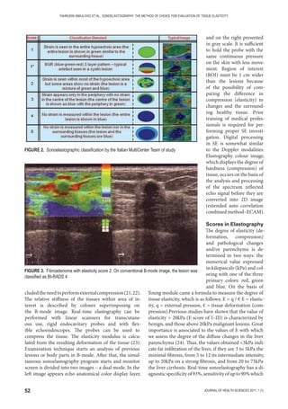 52 JOURNAL OF HEALTH SCIENCES 2011; 1 (1)
FAHRUDIN SMAJLOVIC ET AL.: SONOELASTOGRAPHY: THE METHOD OF CHOICE FOR EVALUATION OF TISSUE ELASTICITY
cludedtheneedtoperformexternalcompression(21,22).
The relative stiffness of the tissues within area of in-
terest is described by colours superimposing on
the B-mode image. Real-time elastography can be
performed with linear scanners for transcutane-
ous use, rigid endocavitary probes and with flex-
ible echoendoscopes. The probes can be used to
compress the tissue. The elasticity modulus is calcu-
lated from the resulting deformation of the tissue (23).
Examination technique starts an analysis of previous
lesions or body parts in B-mode. After that, the simul-
taneous sonoelastography program starts and monitor
screen is divided into two images – a dual mode. In the
left image appears echo anatomical color display layer,
and on the right presented
in gray scale. It is sufficient
to hold the probe with the
same continuous pressure
on the skin with less move-
ment. Region of interest
(ROI) must be 1 cm wider
than the lesions because
of the possibility of com-
paring the difference in
compression (elasticity) to
changes and the surround-
ing healthy tissue. Prior
training of medical profes-
sionals is required for per-
forming proper SE investi-
gation. Digital processing
in SE is somewhat similar
to the Doppler modalities.
Elastography colour image,
which displays the degree of
hardness (compression) of
tissue, occurs on the basis of
the analysis and processing
of the spectrum reflected
echo signal before they are
converted into 2D image
(extended auto correlation
combined method–ECAM).
Scores in Elastography
The degree of elasticity (de-
formation, compression)
and pathological changes
and/or parenchyma is de-
termined in two ways: the
numerical value expressed
in kilopascals (kPa) and col-
oring with one of the three
primary colors: red, green
and blue. On the basis of
Young module came a formula to measure the degree of
tissue elasticity, which is as follows: E = q / € E = elastic-
ity, q = external pressure, € = tissue deformation (com-
pression).Previous studies have shown that the value of
elasticity  20kPa (E score of I–III) is characterized by
benign, and those above 20kPa malignant lesions. Great
importance is associated to the values of E with which
we assess the degree of the diffuse changes in the liver
parenchyma (24). Thus, the values obtained 3kPa indi-
cate fat infiltration of the liver, if they are 3 to 5kPa the
minimal fibrosis, from 5 to 12 its intermediate intensity,
up to 20kPa on a strong fibrosis, and from 20 to 75kPa
the liver cirrhosis. Real-time sonoelastography has a di-
agnosticspecificityof93%,sensitivityofupto90%which
FIGURE 2. Sonoelastographic classiﬁcation by the Italian MultiCenter Team of study
FIGURE 3. Fibroadenoma with elasticity score 2. On conventional B-mode image, the lesion was
classiﬁed as BI-RADS 4
 