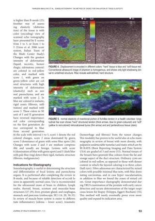 53JOURNAL OF HEALTH SCIENCES 2011; 1 (1)
FAHRUDIN SMAJLOVIC ET AL.: SONOELASTOGRAPHY: THE METHOD OF CHOICE FOR EVALUATION OF TISSUE ELASTICITY
is higher than B-mode (25).
Another way of assess-
ing elasticity (deforma-
tion) of the tissue is with
color (encoding) view of
scanned echo tomography
layer presented by E scores
from 1 to 3, or from 1 to
5 (Ueno et al. 2006 score
system, Italian Team of
the Multi Center Study).
Changes with the greatest
intensity of deformation
(liquid, necrotic, hemor-
rhagic, edematous content)
are colored in red-yellow
color, and marked with
score 1, with green on
green-yellow color are col-
ored structures with high
intensity of deformation
(elasticity) such as nor-
mal parenchyma, and are
marked with score 2. In
blue are colored is inelastic,
rigid zones (fibrosis, infil-
tration) and marked with
score 3. These colors in SE
unit of I and II generation
have reversed importance:
red color corresponding
on the first generation de-
vice correspond to blue
from second generation.
At the scale with interval 1 to 5, score 1 denote the red
colored changes, score 2 areas dominated by green,
score 3 dominance of green with some blue spots (26).
Changes with score 2 and 3 are medium compress-
ible and usually are benign. Lesions with score
4 (domination of blue with green spots) and 5 (dark blue
with pale blue ring) detect their rigid, inelastic structure
(fibrosis, malignancies).
Indications for Elastography
Sonoelastography is useful in determining the structure
and differentiation of focal lesions and parenchyma
organs. It is performed after completing the review in
B-mode, and because of reliable detection of occult le-
sions in apparently normal cases. Use is recommended
for the ultrasound exam of brain in children, lymph
nodes, thyroid, breast, scrotum and muscular-bone
structures (27-29), liver, prostate gland, and esophagus,
stomach and pancreas (endoscopic SE) (14, 20, 30-33).
In review of muscle-bone system is easier to differen-
tiate inflammatory (edema – lower score), traumatic
(hemorrhage and fibrosis) from the tumor changes.
This modality has proven to be useful also at echo mam-
mography in review of breast with more density, with
palpation undetectable tumefact and states which are by
BI-RADS (Brest Reporting Imaging and Data System-
USA) are graded of 3 and more (33). Normal tissues of
the breasts have greenish blue colours from the fat and
orange aspect of the duct structure. Ordinary cysts are
colored in red-yellow, as opposed to those with denser
content in which the layered coloring is in three colors
(bull eyes). Fibro adenomas are characterized by mixed
colors with possible minimal blue note, with blue domi-
nating carcinomas, and in case hyper vascularisation,
in addition to blue we found the zones of mixed col-
ors. Great importance elastography demonstrated dur-
ing TRUS examination of the prostate with early cancer
detection and secure determination of the target suspi-
cious lesion for biopsy (Feloppa, Eggert-Bochum) (34).
This method will surely eventually prove even more
quality and expand its indication area.
FIGURE 4. Displacement is encoded in different colors: “hard” tissue is blue and “soft tissue red.
Conventional ultrasound image of phantom is homogenous, and shows only light shadowing dor-
sal to undeﬁned structure. Rtse reveals well-deﬁned, hard structure.
FIGURE 5. normal elasticity of insertional portion of Achilles tendon in a health volunteer. longi-
tudinal rtse scan shows “hard” structured tendon (thick arrows, blue to green-coloured) and “soft”
(yellow to red-colored) retrocalcaneal bursa (thin arrow) and and peritendinous tissue (stars)
 