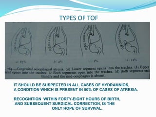 TYPES OF TOF
IT SHOULD BE SUSPECTED IN ALL CASES OF HYDRAMNIOS,
A CONDITION WHICH IS PRESENT IN 50% OF CASES OF ATRESIA.
RECOGNITION WITHIN FORTY-EIGHT HOURS OF BIRTH,
AND SUBSEQUENT SURGICAL CORRECTION, IS THE
ONLY HOPE OF SURVIVAL.
 