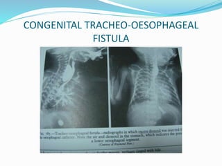 CONGENITAL TRACHEO-OESOPHAGEAL
FISTULA
 