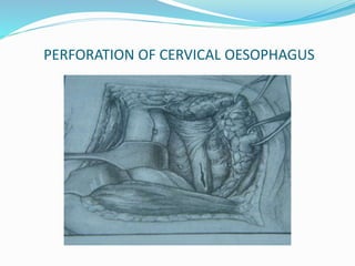 PERFORATION OF CERVICAL OESOPHAGUS
 