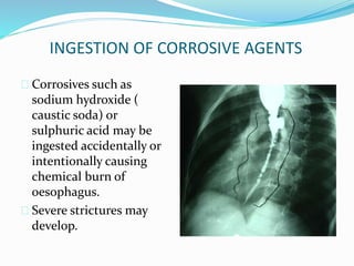 INGESTION OF CORROSIVE AGENTS
 Corrosives such as
sodium hydroxide (
caustic soda) or
sulphuric acid may be
ingested accidentally or
intentionally causing
chemical burn of
oesophagus.
 Severe strictures may
develop.
 