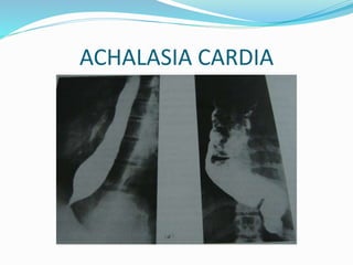ACHALASIA CARDIA
 