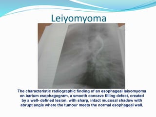 Leiyomyoma
The characteristic radiographic finding of an esophageal leiyomyoma
on barium esophagogram, a smooth concave filling defect, created
by a well- defined lesion, with sharp, intact mucosal shadow with
abrupt angle where the tumour meets the normal esophageal wall.
 
