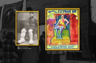 “Milroy’s Disease”.
Photo: Anatomy Box
“Ralph the Elephant Boy”. Artist: Millard & Bulsterbaum.
Photo: Sideshow World.
 