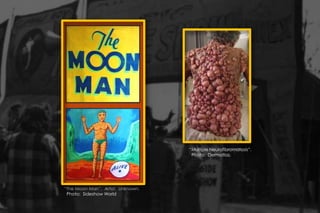 “The Moon Man”. Artist: Unknown.
Photo: Sideshow World
“Multiple Neurofibromatosis”.
Photo: Dermatlas.
 