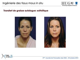 Ingénierie des tissus mous in situ 
Transfert de graisse autologue: esthétique 
University Hospitals of Geneva 
8ème Journée de l’Innovation des HUG – 30 octobre 2014 
 