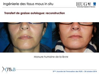 Ingénierie des tissus mous in situ 
Transfert de graisse autologue: reconstruction 
Morsure humaine de la lèvre 
University Hospitals of Geneva 
8ème Journée de l’Innovation des HUG – 30 octobre 2014 
 