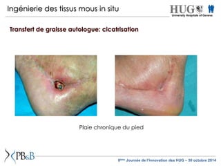Ingénierie des tissus mous in situ 
Transfert de graisse autologue: cicatrisation 
Plaie chronique du pied 
University Hospitals of Geneva 
8ème Journée de l’Innovation des HUG – 30 octobre 2014 
 