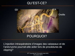 QU’EST-CE? 
POURQUOI? 
Oreille 
OEil ICA 
L’injection intraopératoire d’images des vaisseaux et de 
l’anévrysme pourrait-elle aider lors de procédures de 
clipping? 
8ème Journée de l’Innovation des HUG, 
30 octobre 2014 
 
