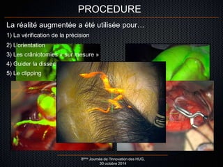 PROCEDURE 
La réalité augmentée a été utilisée pour… 
1) La vérification de la précision 
2) L’orientation 
3) Les crâniotomies « sur mesure » 
4) Guider la dissection 
8ème Journée de l’Innovation des HUG, 
30 octobre 2014 
5) Le clipping 
 