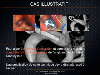 CAS ILLUSTRATIF 
CONCLUSION 
Peut aider à minimiser l’exposition et permet une meilleure 
compréhension intraopératoire de l’angioarchitecture de 
l’anévrysme. 
L’automatisation de cette technique devra être addressé à 
l’avenir. 
8ème Journée de l’Innovation des HUG, 
30 octobre 2014 
 