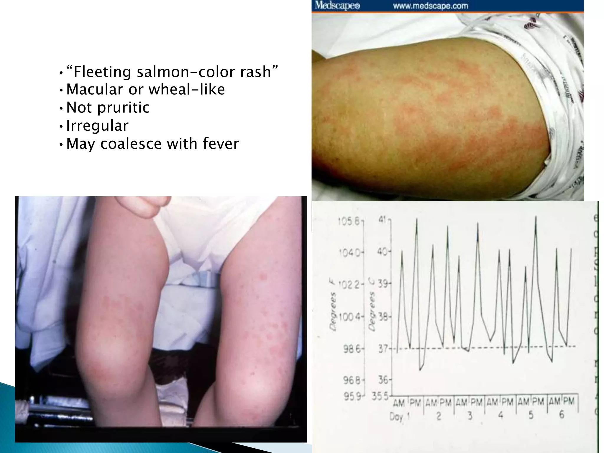 Juvenile Idiopathic Arthritis | PPTX