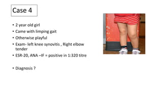 Case 4
• 2 year old girl
• Came with limping gait
• Otherwise playful
• Exam- left knee synovitis , Right elbow
tender
• ESR-20, ANA –IF = positive in 1:320 titre
• Diagnosis ?
 