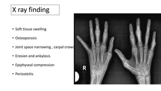 X ray finding
• Soft tissue swelling
• Osteoporosis
• Joint space narrowing , carpal crowding
• Erosion and ankylosis
• Epiphyseal compression
• Periosteitis
 