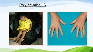 Poly Jia juvelnile idiopathic arthritis | PPT | Bone and Joint Conditions ...