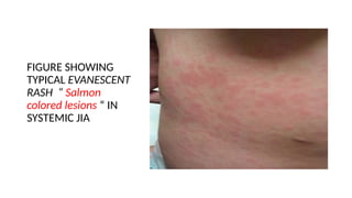 FIGURE SHOWING
TYPICAL EVANESCENT
RASH “ Salmon
colored lesions “ IN
SYSTEMIC JIA
 