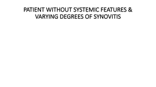PATIENT WITHOUT SYSTEMIC FEATURES &
VARYING DEGREES OF SYNOVITIS
 