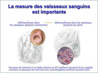 La mesure des vaisseaux sanguins est importante Ath é roscl é rose  dans les vaisseaux sanguins coronariens Ath é roscl é rose  dans les vaisseaux sanguins du pénis Pourquoi les hommes à un stade précoce de ED souffrent rarement d’une maladie coronaire et pourquoi les hommes avec coronaropathie souffrent souvent d’ED… 