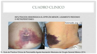 CUADRO CLINICO
INFILTRACION HEMORÁGICA DL EPIPLÓN MENOR, LIGAMENTO REDONDO
O RETROPERITONEO.
5.- Guía de Practica Clínica de Pancreatitis Aguda Asociación Mexicana de Cirugía General México 2014.
 