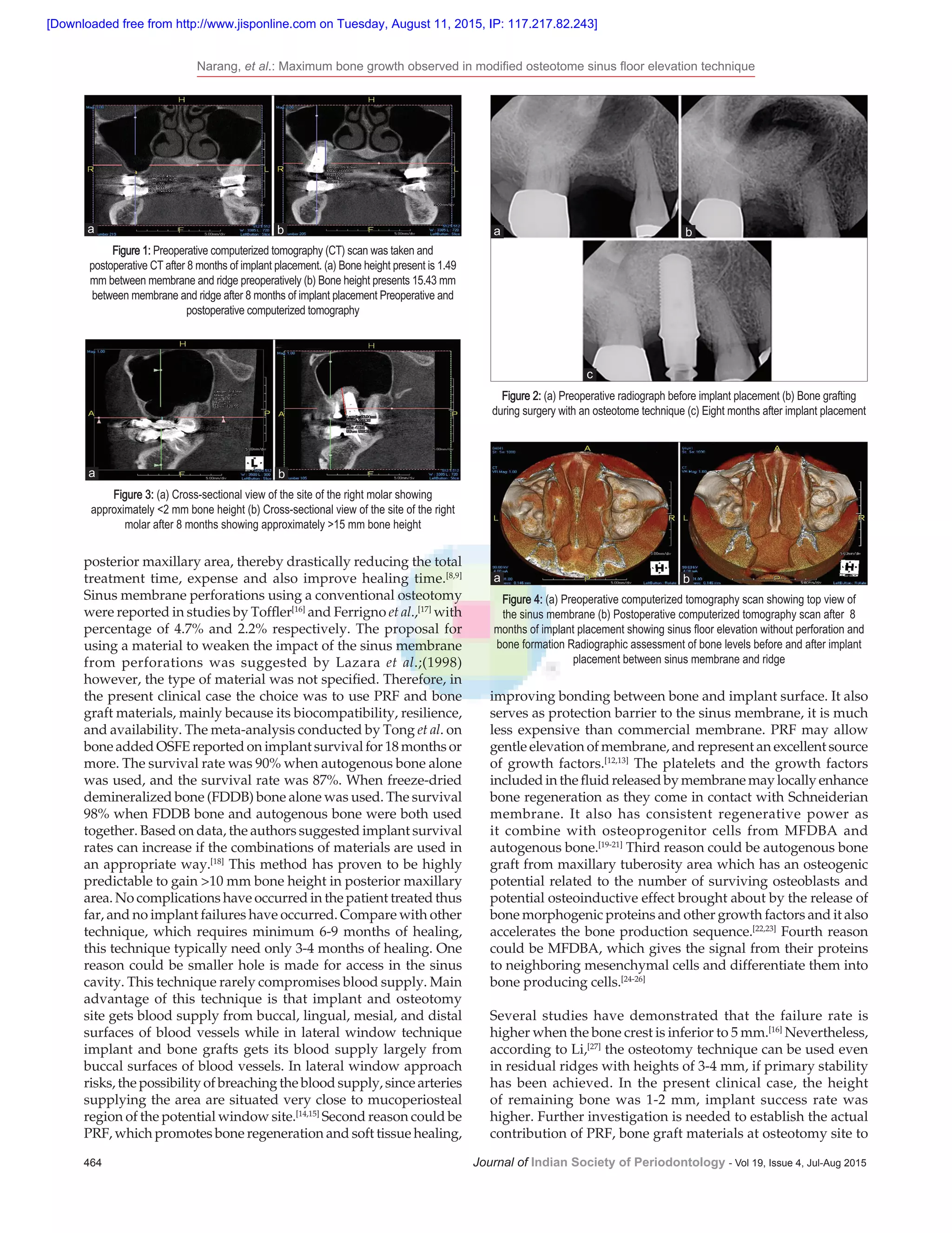 Modified osteotome sinus floor elevation by using combination PRF ...