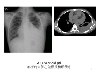 A 14-year-old girl
狼瘡病合併心包膜及肋膜積水

13

 