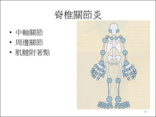 脊椎關節炎
• 中軸關節
• 周邊關節
• 肌腱附著點

20

 