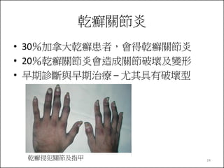 乾癬關節炎
• 30％加拿大乾癬患者，會得乾癬關節炎
• 20％乾癬關節炎會造成關節破壞及變形
• 早期診斷與早期治療 – 尤其具有破壞型

乾癬侵犯關節及指甲

24

 