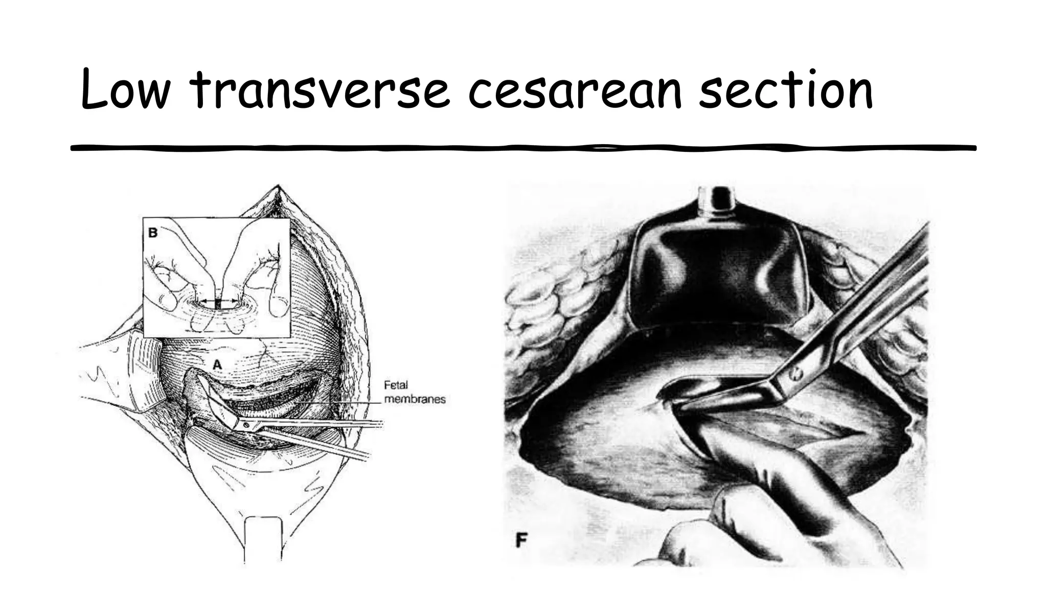 Low transverse cesarean section