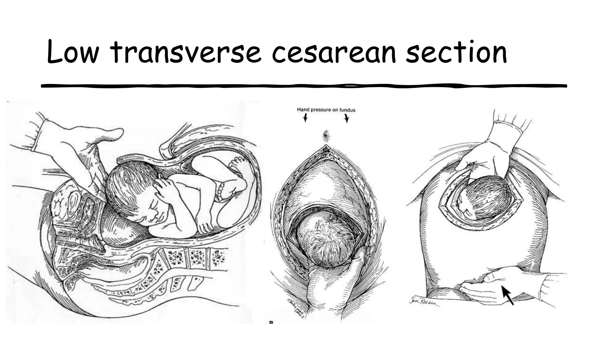 Low transverse cesarean section
