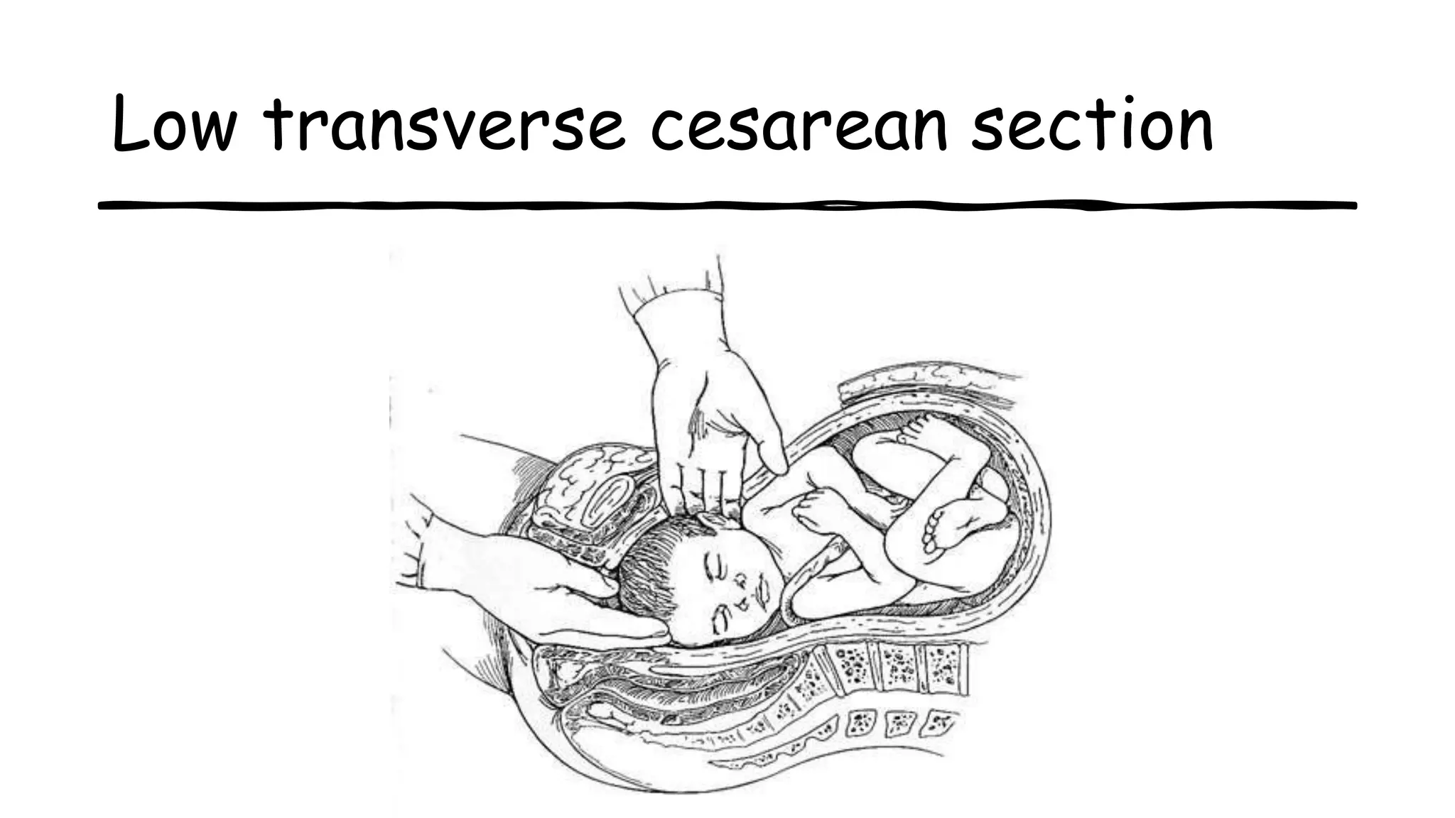 Low transverse cesarean section