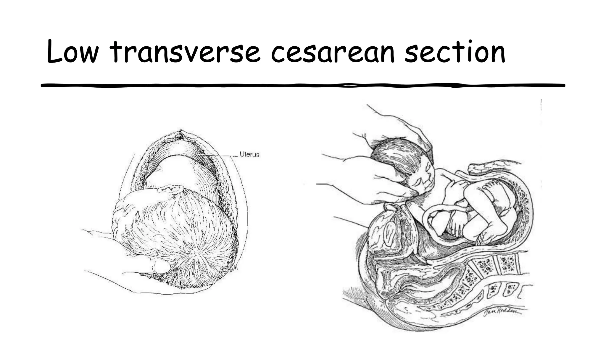 Low transverse cesarean section