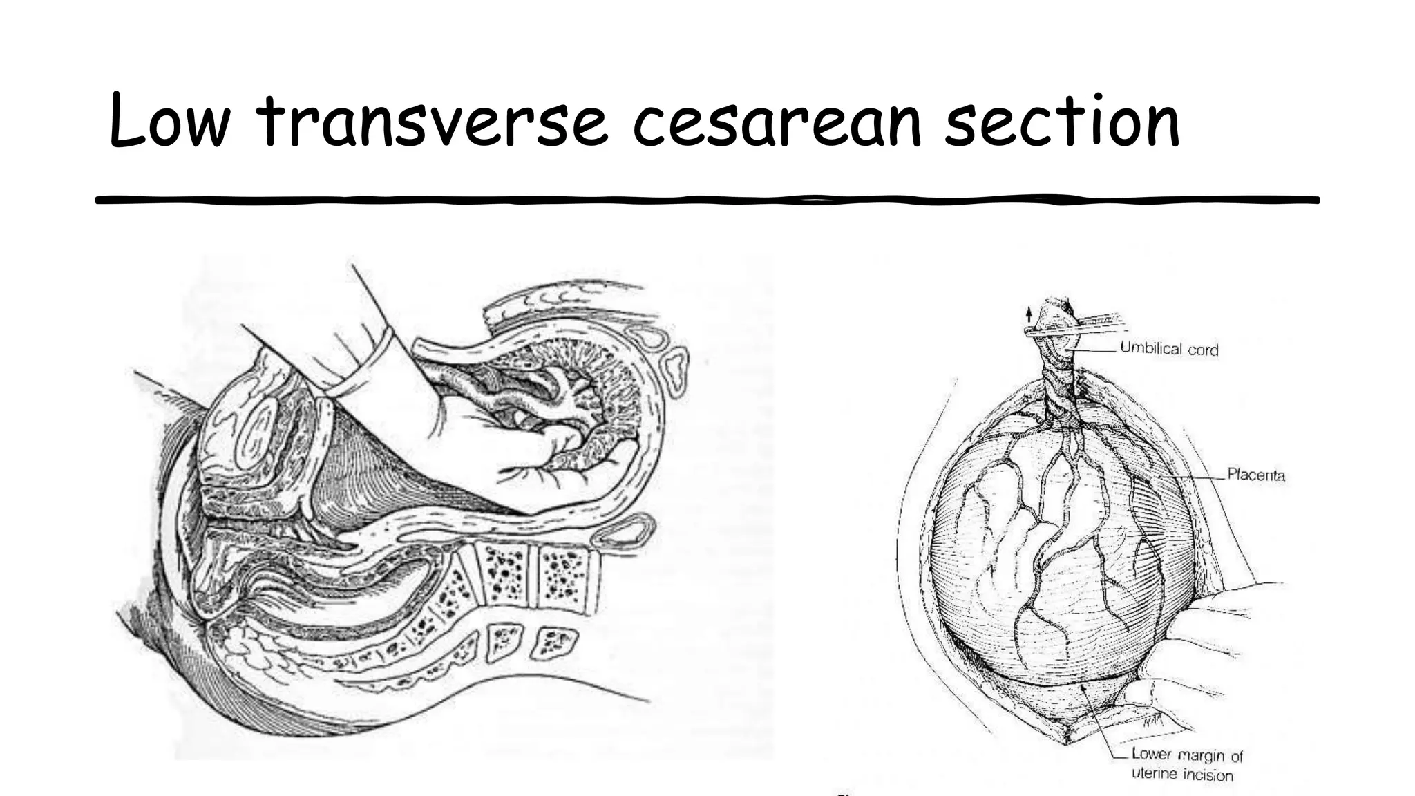 Low transverse cesarean section